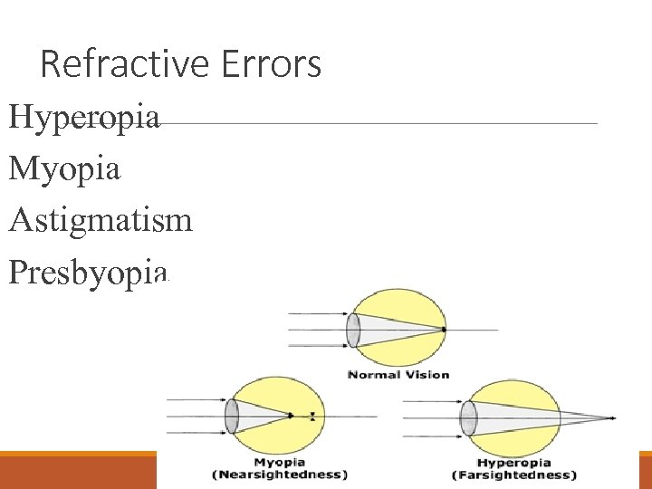 Refractive Errors Hyperopia Myopia Astigmatism Presbyopia 
