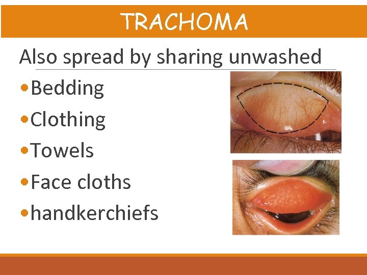 TRACHOMA Also spread by sharing unwashed • Bedding • Clothing • Towels • Face