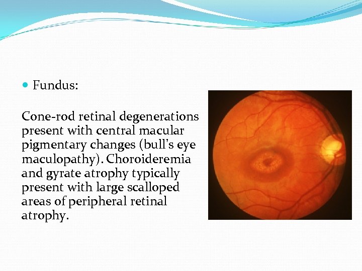  Fundus: Cone-rod retinal degenerations present with central macular pigmentary changes (bull's eye maculopathy).