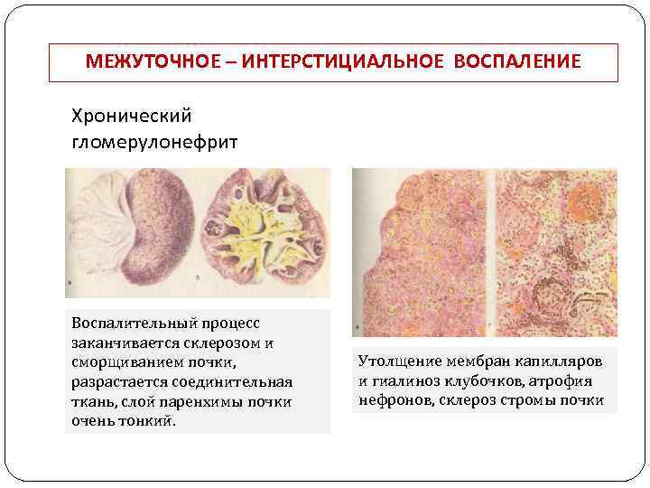 МЕЖУТОЧНОЕ – ИНТЕРСТИЦИАЛЬНОЕ ВОСПАЛЕНИЕ Хронический гломерулонефрит Воспалительный процесс заканчивается склерозом и сморщиванием почки, разрастается