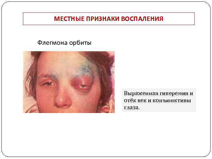 МЕСТНЫЕ ПРИЗНАКИ ВОСПАЛЕНИЯ Флегмона орбиты Выраженная гиперемия и отёк век и конъюнктивы глаза. 