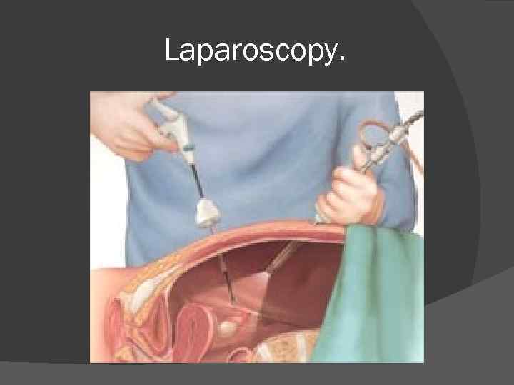 Laparoscopy. 