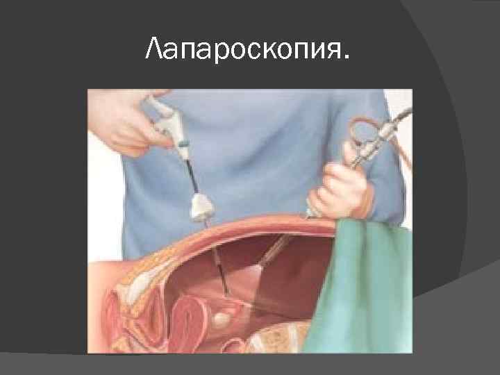 Лапароскопия. 