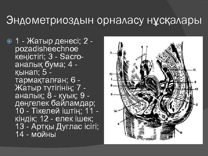 Эндометриоздын орналасу нұсқалары 1 - Жатыр денесі; 2 - pozadisheechnoe кеңістігі; 3 - Sacroаналық
