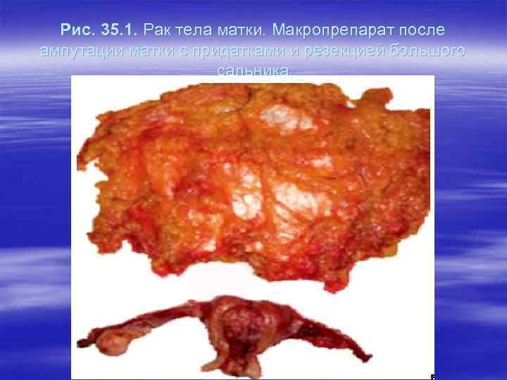 Рис. 35. 1. Рак тела матки. Макропрепарат после ампутации матки с придатками и резекцией