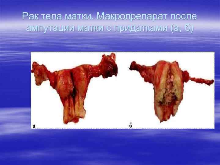 Рак тела матки. Макропрепарат после ампутации матки с придатками (а, б) 