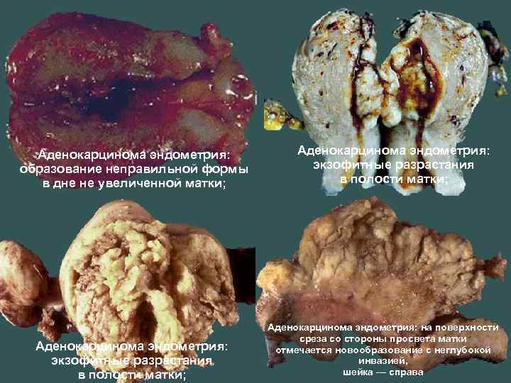 Аденокарцинома эндометрия: образование неправильной формы в дне не увеличенной матки; Аденокарцинома эндометрия: экзофитные разрастания