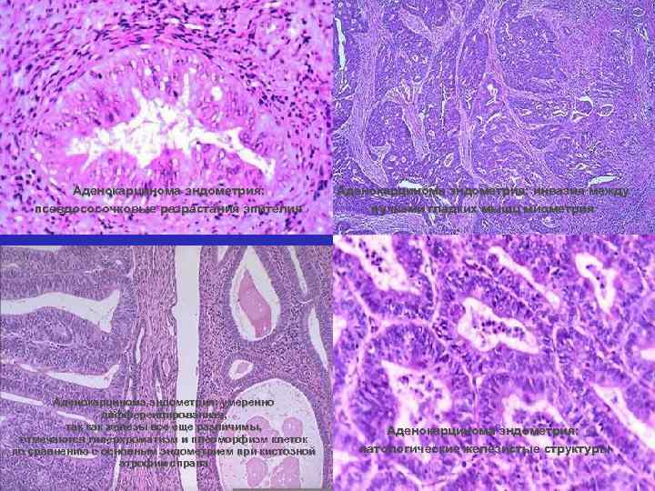 Аденокарцинома эндометрия: псевдососочковые разрастания эпителия Аденокарцинома эндометрия: умеренно дифференцированная, так как железы все еще