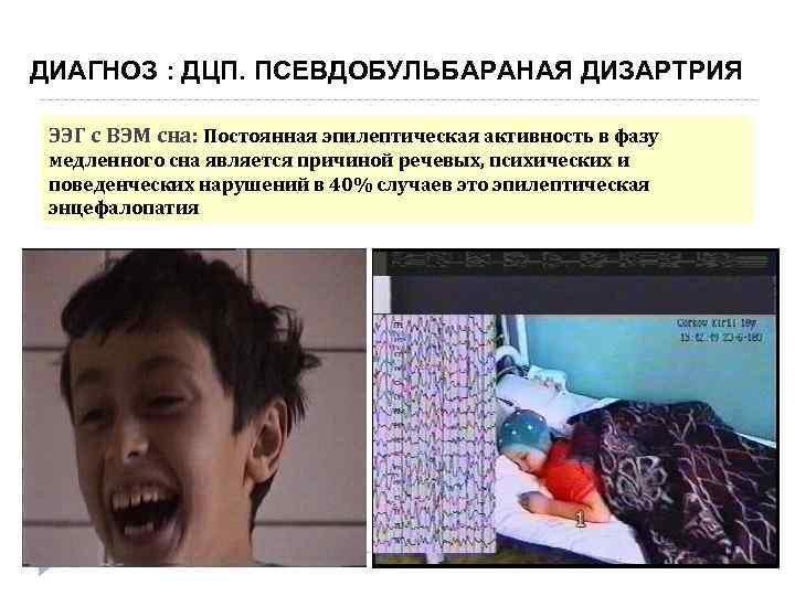 ДИАГНОЗ : ДЦП. ПСЕВДОБУЛЬБАРАНАЯ ДИЗАРТРИЯ ЭЭГ с ВЭМ сна: Постоянная эпилептическая активность в фазу