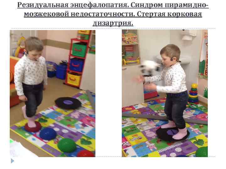 Резидуальная энцефалопатия. Синдром пирамидномозжековой недостаточности. Стертая корковая дизартрия. 