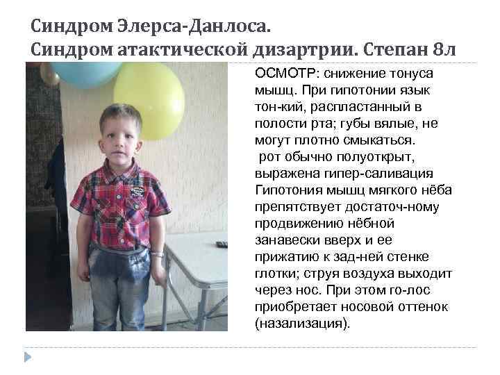 Синдром Элерса-Данлоса. Синдром атактической дизартрии. Степан 8 л ОСМОТР: снижение тонуса мышц. При гипотонии