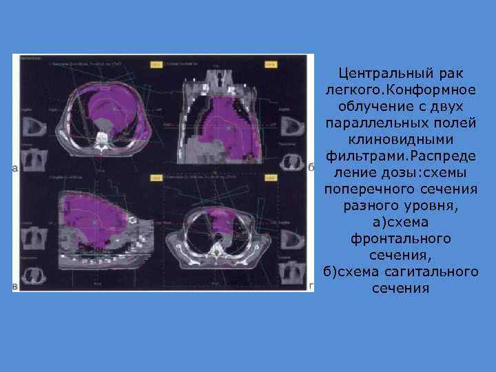 Центральный рак легкого. Конформное облучение с двух параллельных полей клиновидными фильтрами. Распреде ление дозы: