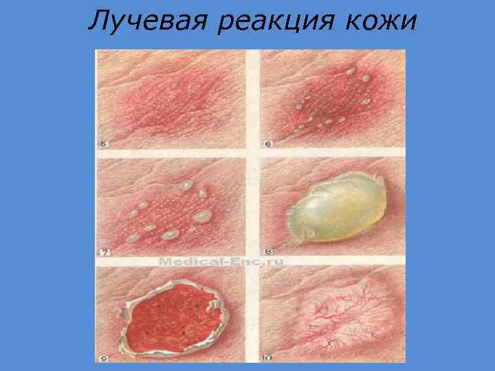 Лучевая реакция кожи 