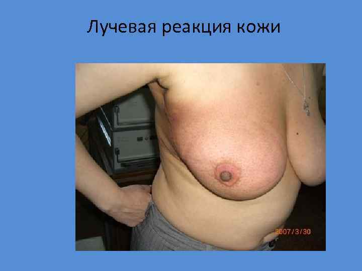 Лучевая реакция кожи 