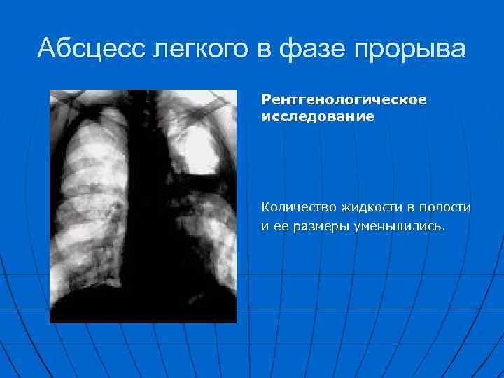 Абсцесс легкого в фазе прорыва Рентгенологическое исследование Количество жидкости в полости и ее размеры