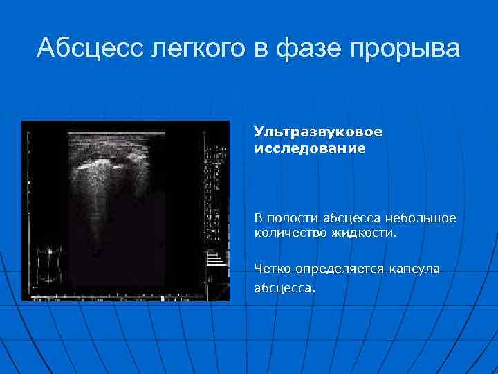 Абсцесс легкого в фазе прорыва Ультразвуковое исследование В полости абсцесса небольшое количество жидкости. Четко