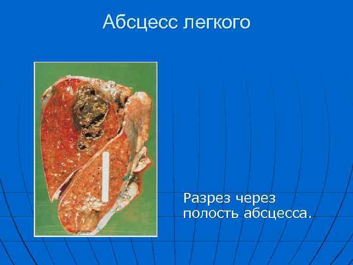 Абсцесс легкого Разрез через полость абсцесса. 
