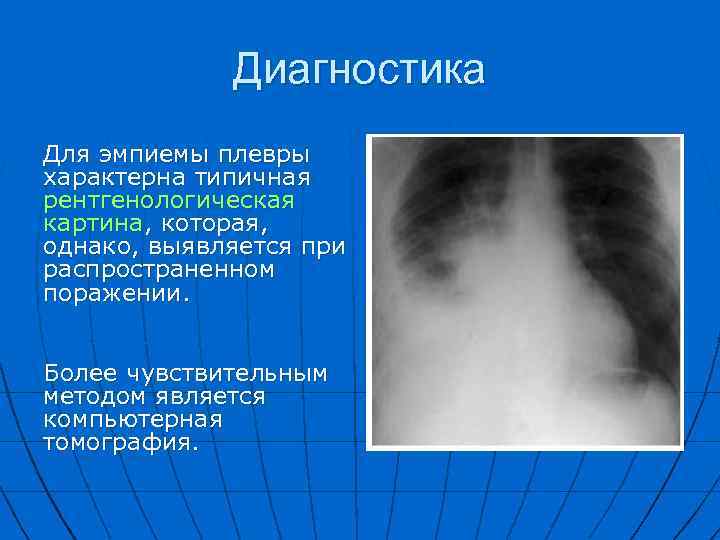 Диагностика Для эмпиемы плевры характерна типичная рентгенологическая картина, которая, однако, выявляется при распространенном поражении.