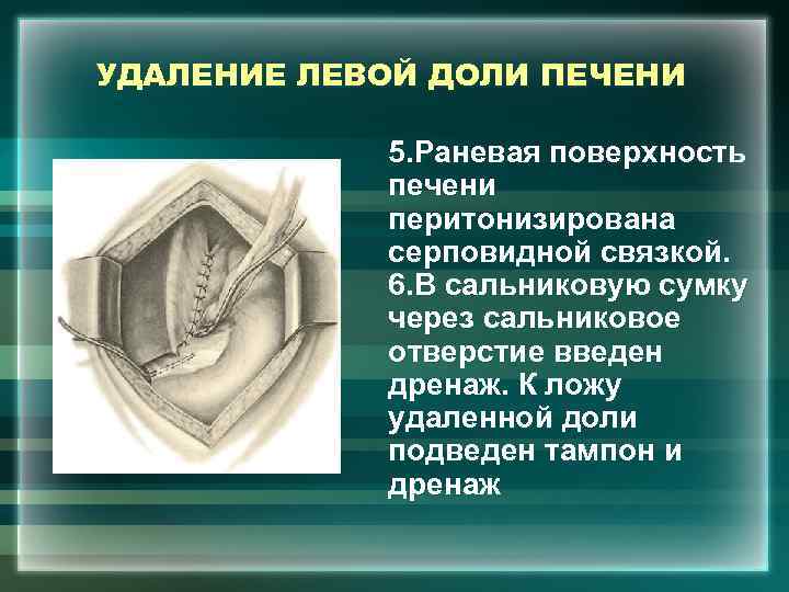 УДАЛЕНИЕ ЛЕВОЙ ДОЛИ ПЕЧЕНИ 5. Раневая поверхность печени перитонизирована серповидной связкой. 6. В сальниковую