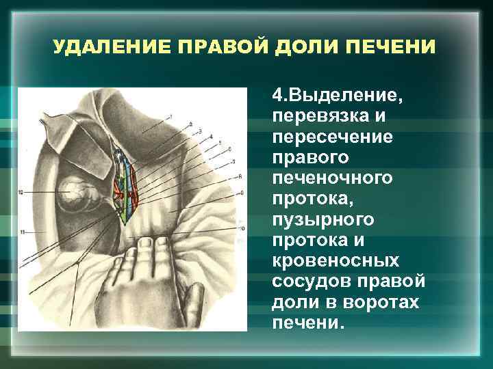 УДАЛЕНИЕ ПРАВОЙ ДОЛИ ПЕЧЕНИ 4. Выделение, перевязка и пересечение правого печеночного протока, пузырного протока