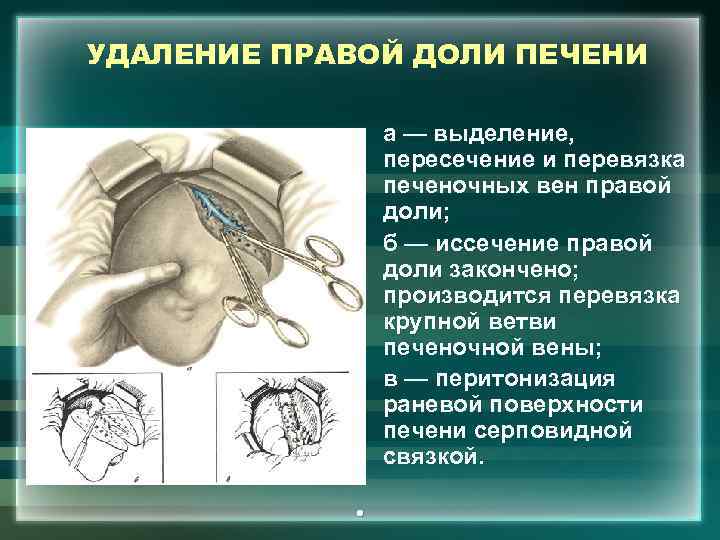 УДАЛЕНИЕ ПРАВОЙ ДОЛИ ПЕЧЕНИ а — выделение, пересечение и перевязка печеночных вен правой доли;