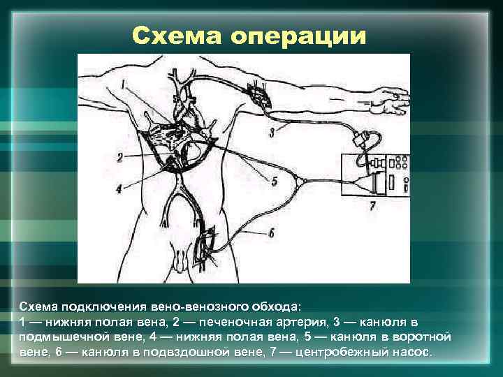 Схема операции Схема подключения вено-венозного обхода: 1 — нижняя полая вена, 2 — печеночная