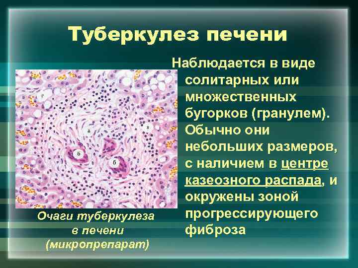 Туберкулез печени Наблюдается в виде солитарных или множественных бугорков (гранулем). Обычно они небольших размеров,