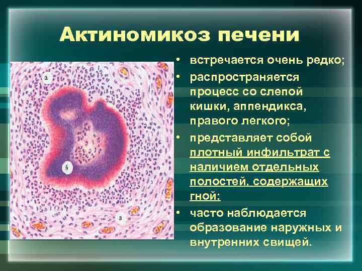 Актиномикоз печени • встречается очень редко; • распространяется процесс со слепой кишки, аппендикса, правого