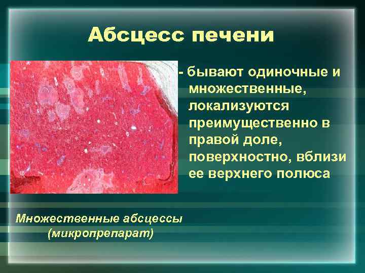 Абсцесс печени - бывают одиночные и множественные, локализуются преимущественно в правой доле, поверхностно, вблизи