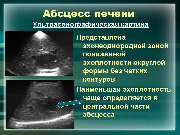 Абсцесс печени Ультрасонографическая картина Представлена эхонеоднородной зоной пониженной эхоплотности округлой формы без четких контуров