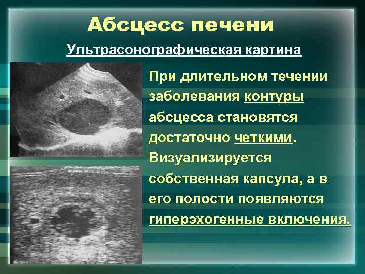 Абсцесс печени Ультрасонографическая картина При длительном течении заболевания контуры абсцесса становятся достаточно четкими. Визуализируется