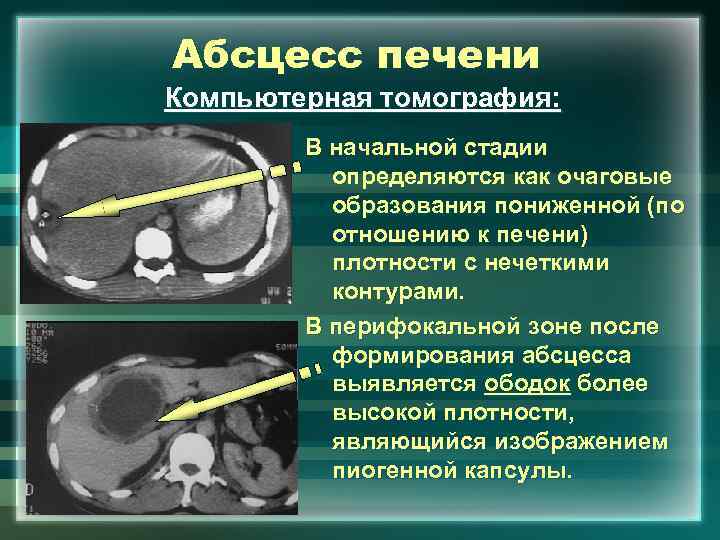 Абсцесс печени Компьютерная томография: В начальной стадии определяются как очаговые образования пониженной (по отношению