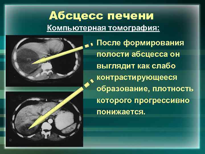 Абсцесс печени Компьютерная томография: После формирования полости абсцесса он выглядит как слабо контрастирующееся образование,