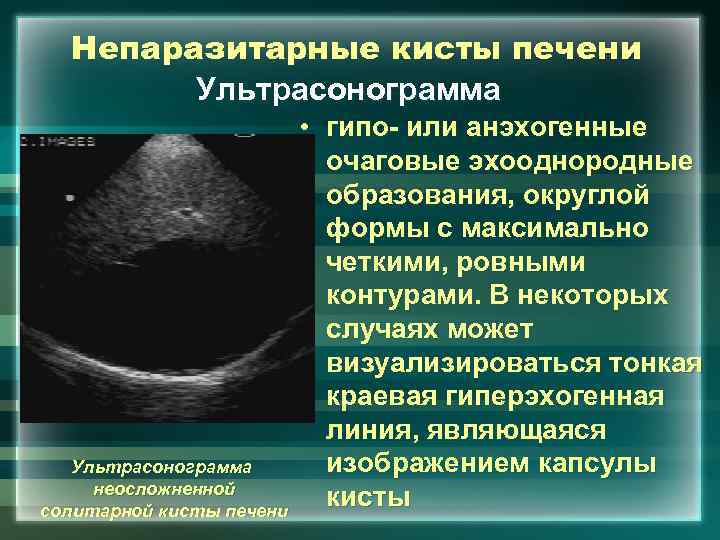 Непаразитарные кисты печени Ультрасонограмма неосложненной солитарной кисты печени • гипо- или анэхогенные очаговые эхооднородные