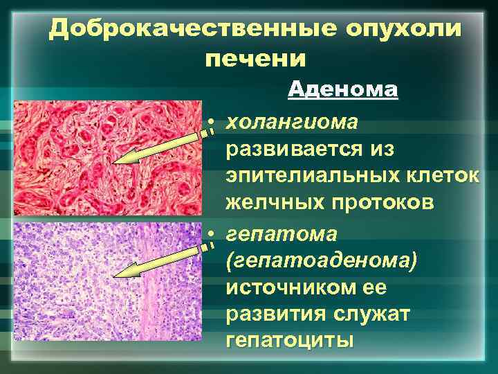 Доброкачественные опухоли печени Аденома • холангиома развивается из эпителиальных клеток желчных протоков • гепатома