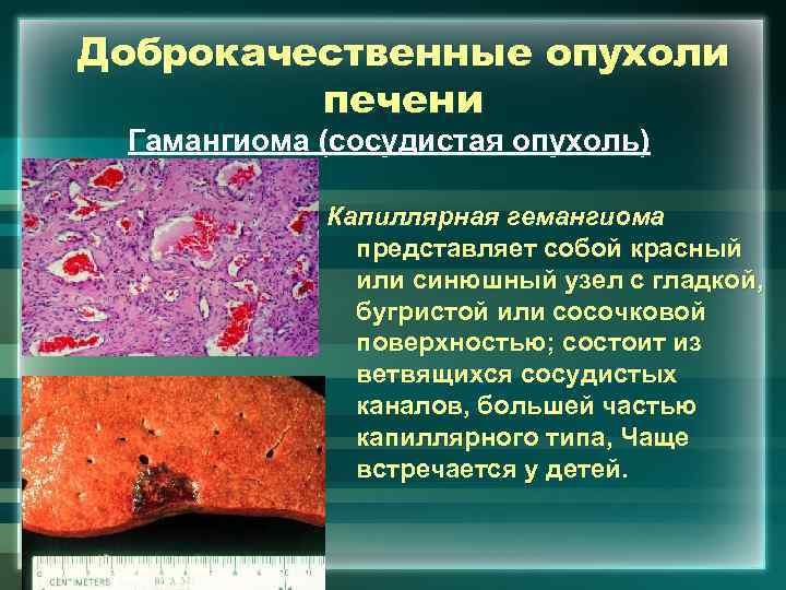 Доброкачественные опухоли печени Гамангиома (сосудистая опухоль) Капиллярная гемангиома представляет собой красный или синюшный узел