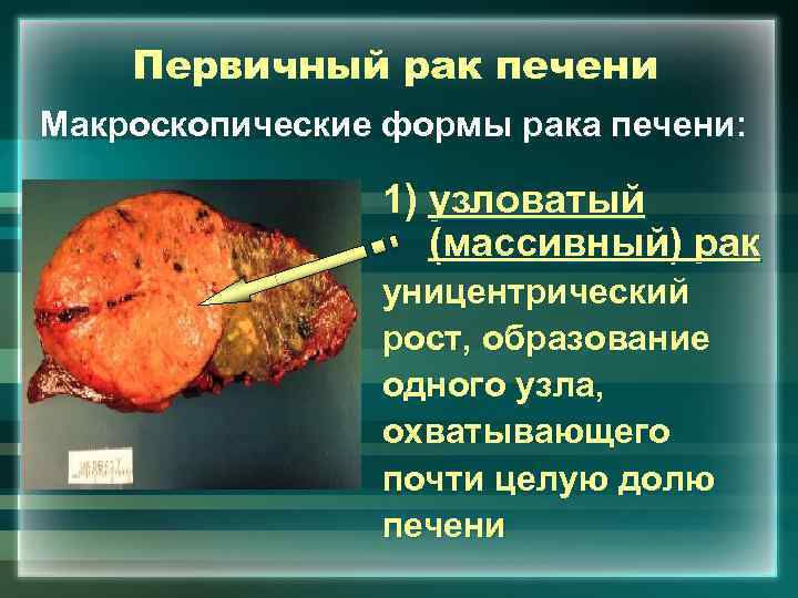 Первичный рак печени Макроскопические формы рака печени: 1) узловатый (массивный) рак уницентрический рост, образование