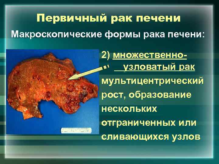 Первичный рак печени Макроскопические формы рака печени: 2) множественноузловатый рак мультицентрический рост, образование нескольких