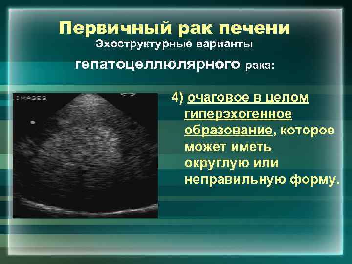 Первичный рак печени Эхоструктурные варианты гепатоцеллюлярного рака: 4) очаговое в целом гиперэхогенное образование, которое