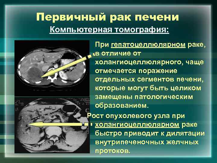 Первичный рак печени Компьютерная томография: При гепатоцеллюлярном раке, в отличие от холангиоцеллюлярного, чаще отмечается