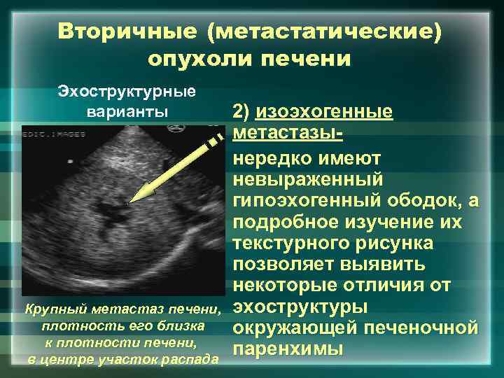 Вторичные (метастатические) опухоли печени Эхоструктурные варианты Крупный метастаз печени, плотность его близка к плотности