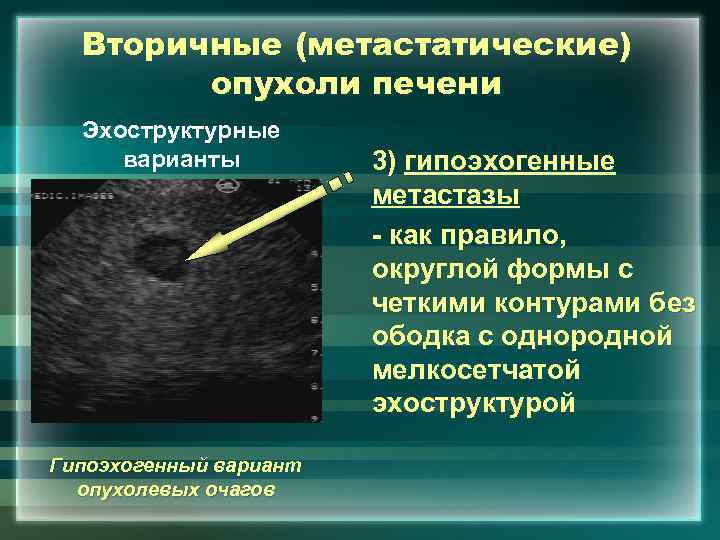 Вторичные (метастатические) опухоли печени Эхоструктурные варианты Гипоэхогенный вариант опухолевых очагов 3) гипоэхогенные метастазы -