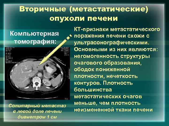 Вторичные (метастатические) опухоли печени Компьютерная томография: Солитарный метастаз в левой доле печени диаметром 1