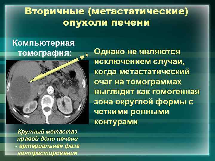 Вторичные (метастатические) опухоли печени Компьютерная томография: Крупный метастаз правой доли печени - артериальная фаза