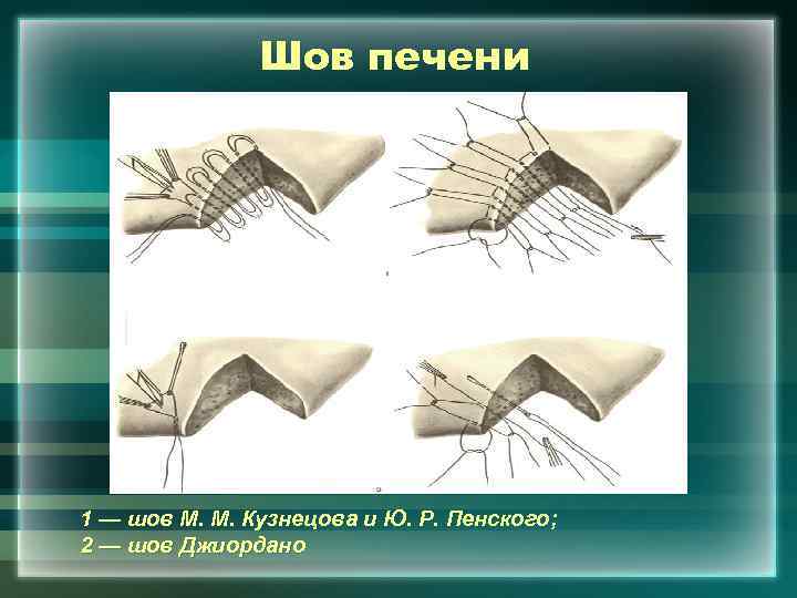 Шов печени 1 — шов М. М. Кузнецова и Ю. Р. Пенского; 2 —