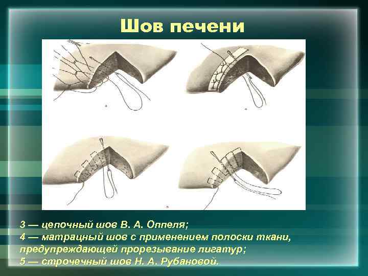 Шов печени 3 — цепочный шов В. А. Оппеля; 4 — матрацный шов с