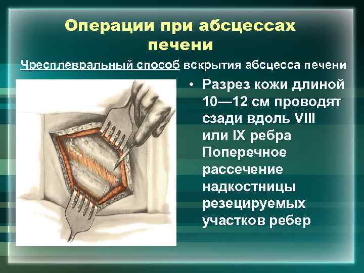 Операции при абсцессах печени Чресплевральный способ вскрытия абсцесса печени • Разрез кожи длиной 10—