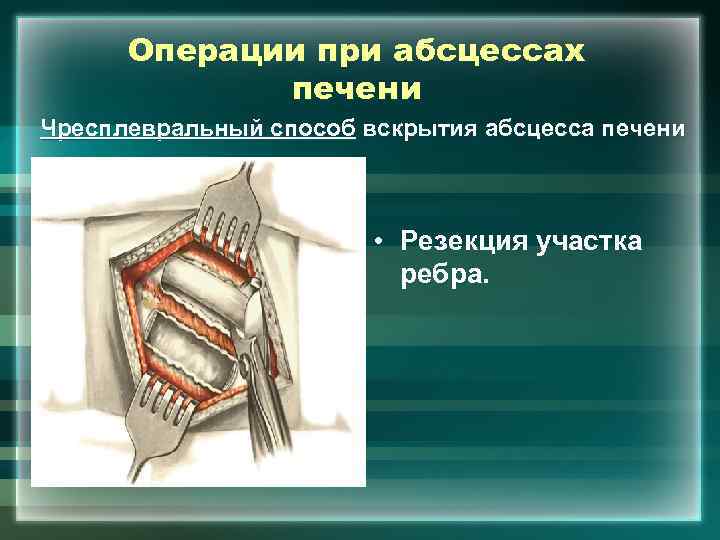 Операции при абсцессах печени Чресплевральный способ вскрытия абсцесса печени • Резекция участка ребра. 