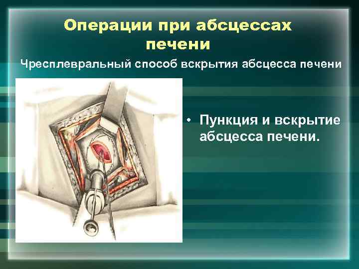 Операции при абсцессах печени Чресплевральный способ вскрытия абсцесса печени • Пункция и вскрытие абсцесса