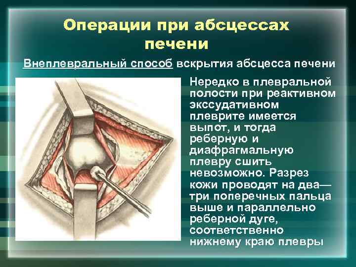 Операции при абсцессах печени Внеплевральный способ вскрытия абсцесса печени • Нередко в плевральной полости